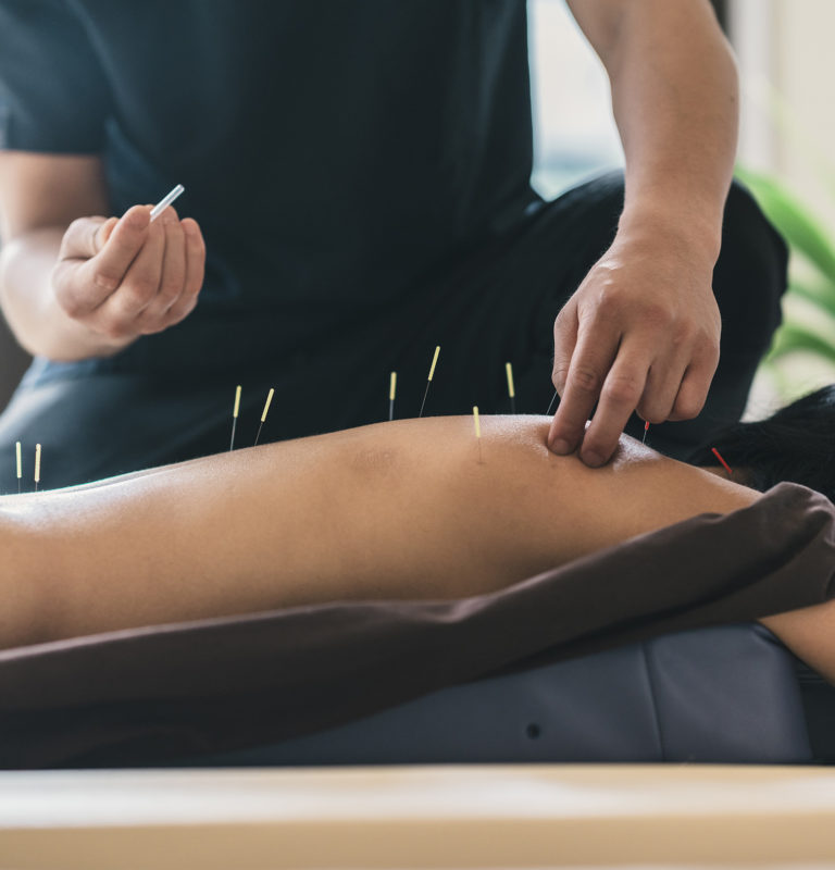 Physiotherapist Giving Accupuncture Treatment To Young Woman